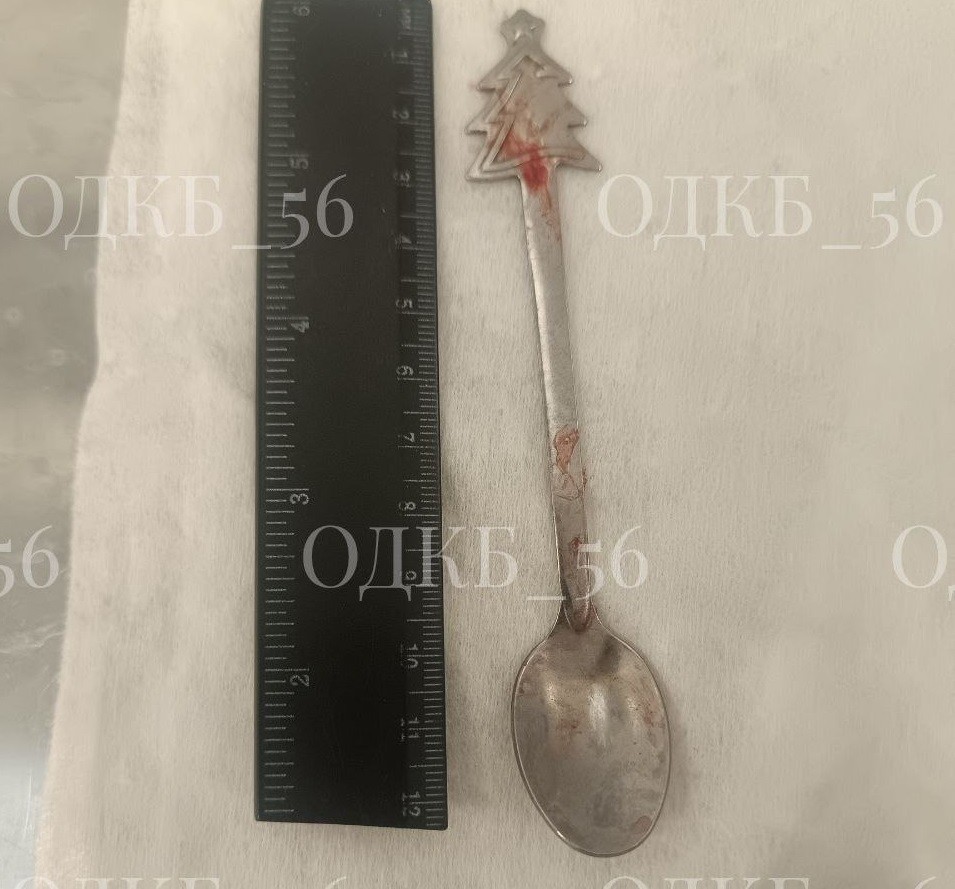 Оренбургские врачи извлекли 14‑сантиметровую ложку из желудка ребёнка