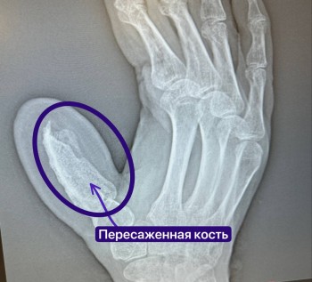 Новый палец на руке вырастили пациенту в Татарстане