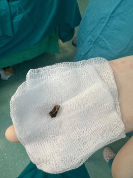 Врачи в Татарстане удалили осколок у бойца СВО