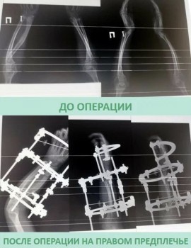 Кировские врачи помогли близняшкам с редкой болезнью Маделунга